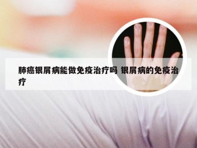 肺癌银屑病能做免疫治疗吗 银屑病的免疫治疗
