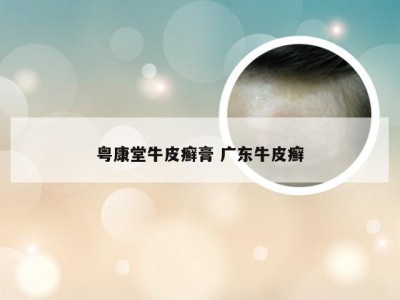 粤康堂牛皮癣膏 广东牛皮癣
