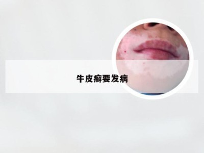 牛皮癣要发病