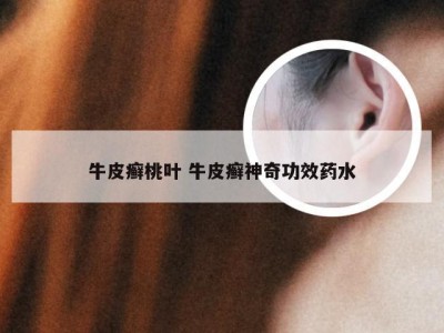 牛皮癣桃叶 牛皮癣神奇功效药水