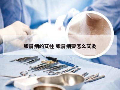 银屑病的艾柱 银屑病要怎么艾灸