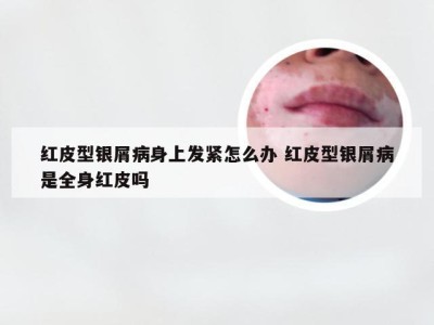 红皮型银屑病身上发紧怎么办 红皮型银屑病是全身红皮吗