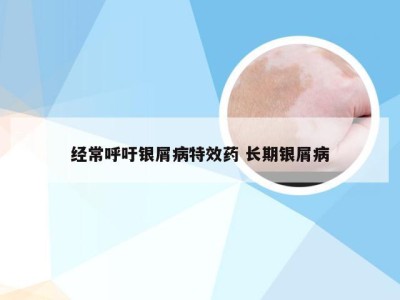 经常呼吁银屑病特效药 长期银屑病
