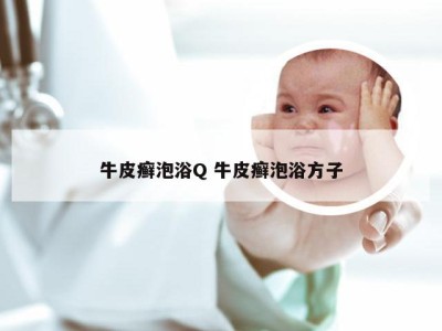 牛皮癣泡浴Q 牛皮癣泡浴方子