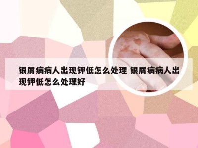 银屑病病人出现钾低怎么处理 银屑病病人出现钾低怎么处理好