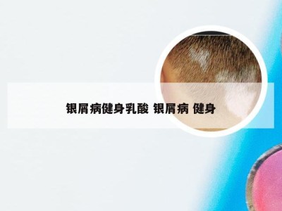 银屑病健身乳酸 银屑病 健身