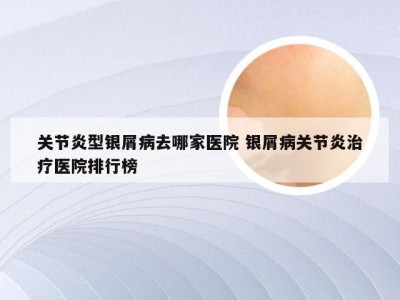 关节炎型银屑病去哪家医院 银屑病关节炎治疗医院排行榜