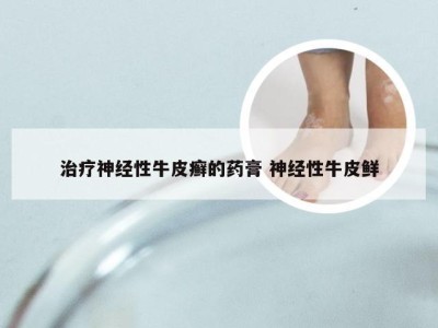 治疗神经性牛皮癣的药膏 神经性牛皮鲜