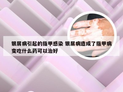 银屑病引起的指甲感染 银屑病造成了指甲病变吃什么药可以治好