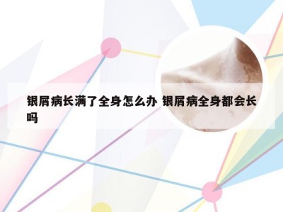 银屑病长满了全身怎么办 银屑病全身都会长吗