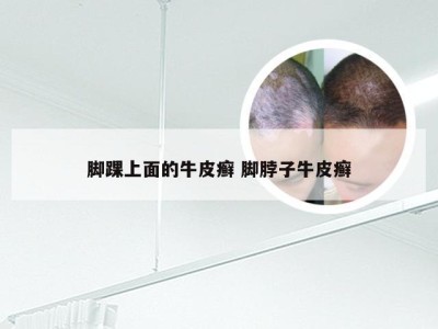 脚踝上面的牛皮癣 脚脖子牛皮癣