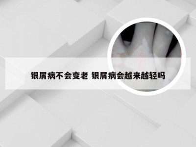 银屑病不会变老 银屑病会越来越轻吗