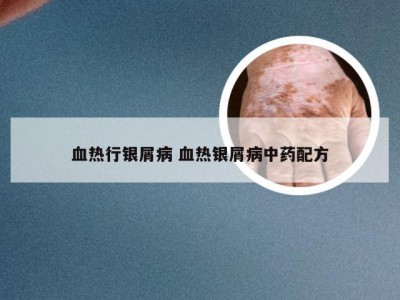 血热行银屑病 血热银屑病中药配方