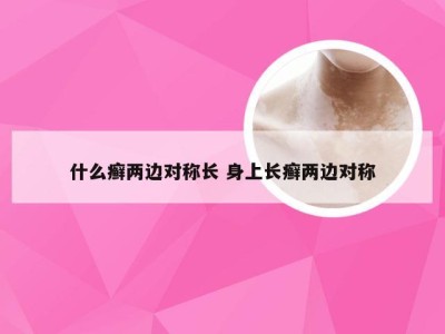 什么癣两边对称长 身上长癣两边对称