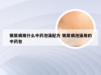 银屑病用什么中药泡澡配方 银屑病泡澡用的中药包