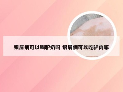 银屑病可以喝驴奶吗 银屑病可以吃驴肉嘛