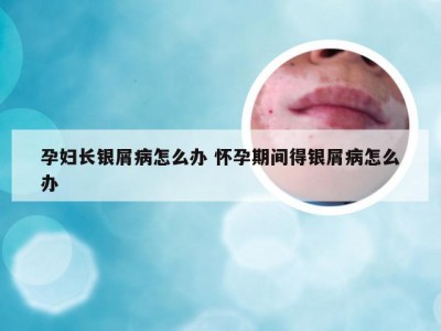 孕妇长银屑病怎么办 怀孕期间得银屑病怎么办