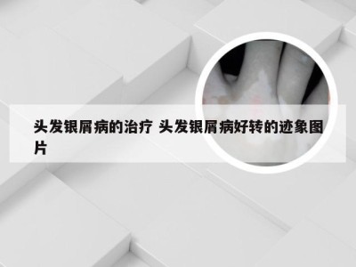 头发银屑病的治疗 头发银屑病好转的迹象图片