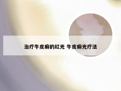 治疗牛皮癣的红光 牛皮癣光疗法