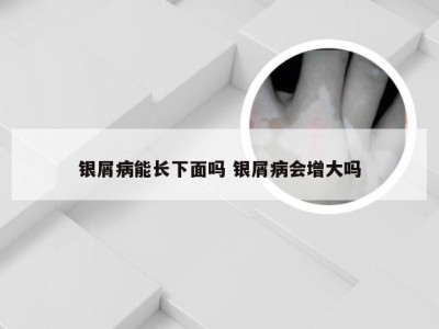 银屑病能长下面吗 银屑病会增大吗