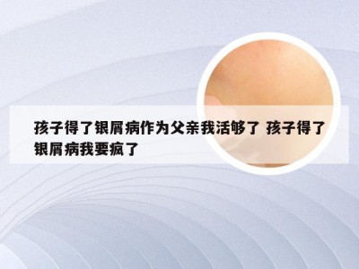 孩子得了银屑病作为父亲我活够了 孩子得了银屑病我要疯了