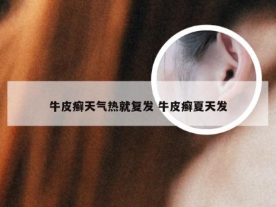牛皮癣天气热就复发 牛皮癣夏天发