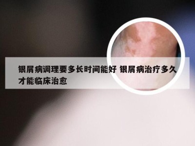 银屑病调理要多长时间能好 银屑病治疗多久才能临床治愈