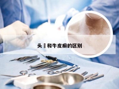 头廯和牛皮癣的区别