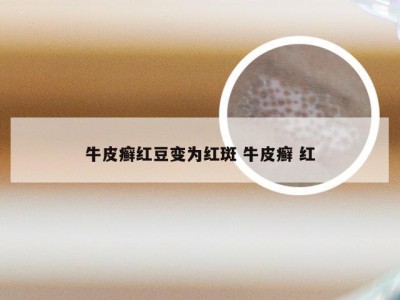 牛皮癣红豆变为红斑 牛皮癣 红