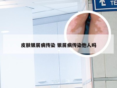 皮肤银屑病传染 银屑病传染他人吗