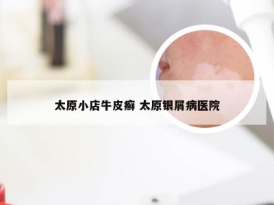 太原小店牛皮癣 太原银屑病医院
