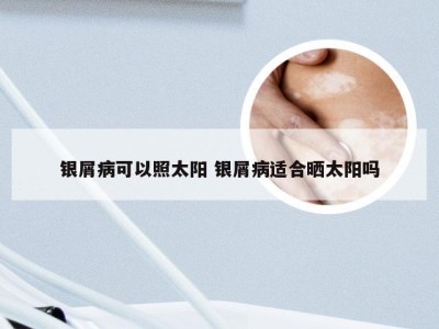银屑病可以照太阳 银屑病适合晒太阳吗