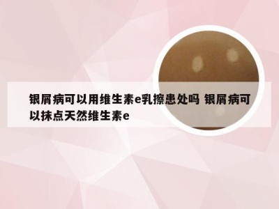 银屑病可以用维生素e乳擦患处吗 银屑病可以抹点天然维生素e