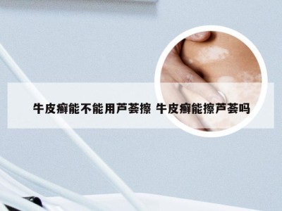 牛皮癣能不能用芦荟擦 牛皮癣能擦芦荟吗