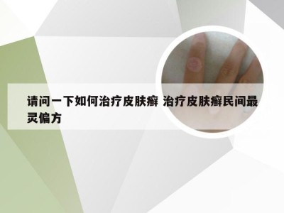 请问一下如何治疗皮肤癣 治疗皮肤癣民间最灵偏方