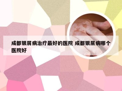 成都银屑病治疗最好的医院 成都银屑病哪个医院好