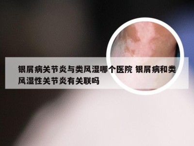 银屑病关节炎与类风湿哪个医院 银屑病和类风湿性关节炎有关联吗