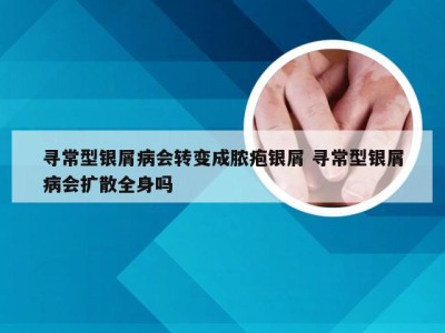 寻常型银屑病会转变成脓疱银屑 寻常型银屑病会扩散全身吗