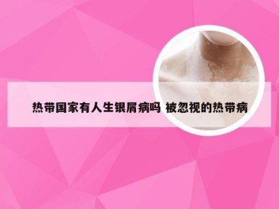 热带国家有人生银屑病吗 被忽视的热带病