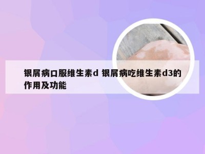 银屑病口服维生素d 银屑病吃维生素d3的作用及功能