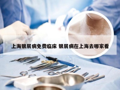 上海银屑病免费临床 银屑病在上海去哪家看