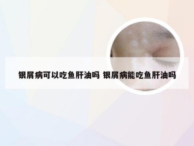 银屑病可以吃鱼肝油吗 银屑病能吃鱼肝油吗