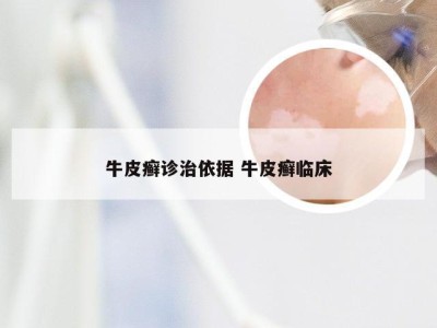 牛皮癣诊治依据 牛皮癣临床