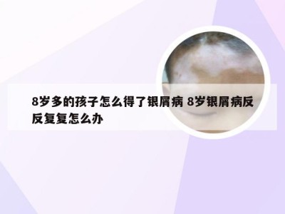 8岁多的孩子怎么得了银屑病 8岁银屑病反反复复怎么办