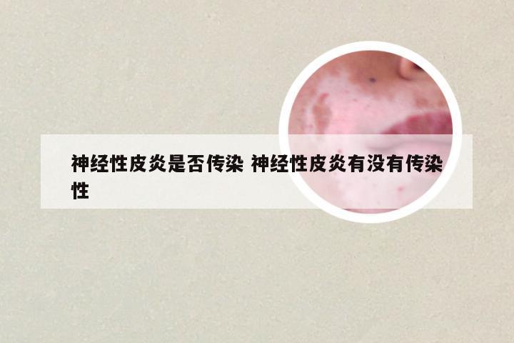 神经性皮炎是否传染 神经性皮炎有没有传染性