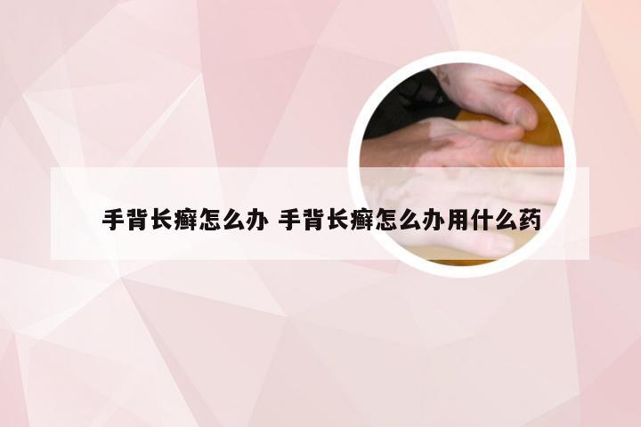 手背长癣怎么办 手背长癣怎么办用什么药
