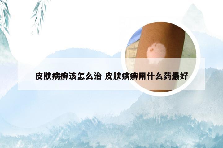 皮肤病癣该怎么治 皮肤病癣用什么药最好