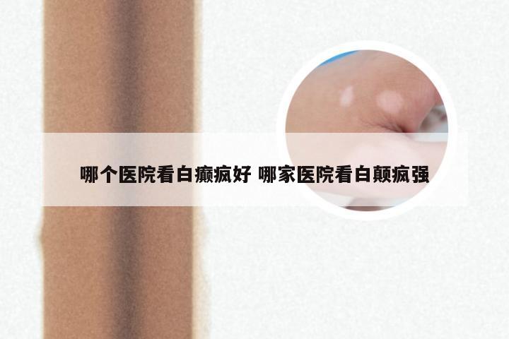哪个医院看白癫疯好 哪家医院看白颠疯强