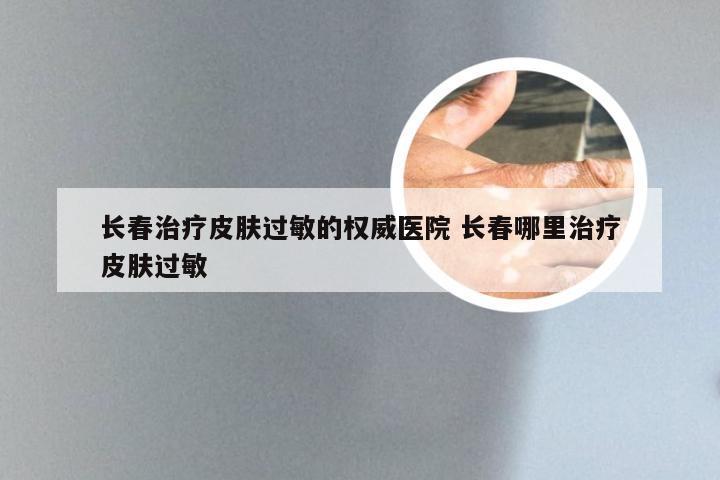 长春治疗皮肤过敏的权威医院 长春哪里治疗皮肤过敏