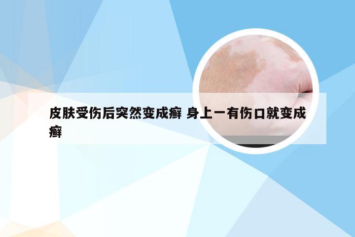 皮肤受伤后突然变成癣 身上一有伤口就变成癣